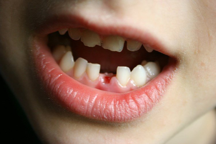 Trẻ bị gãy răng sữa có mọc lại không?