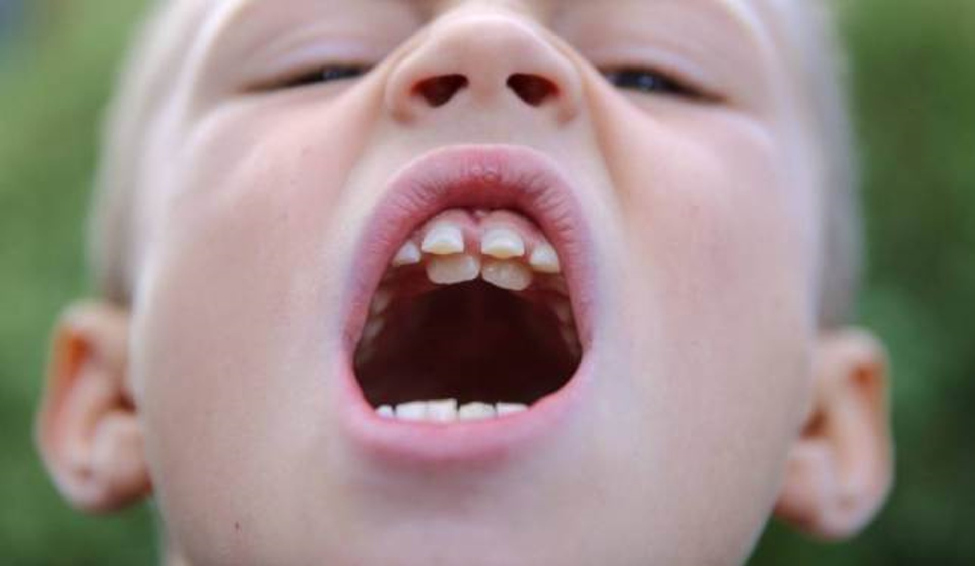 trẻ thay răng mọc lệch