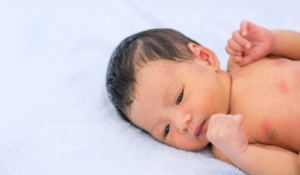 Những phương pháp điều trị rôm sảy ở trẻ sơ sinh an toàn và hiệu quả